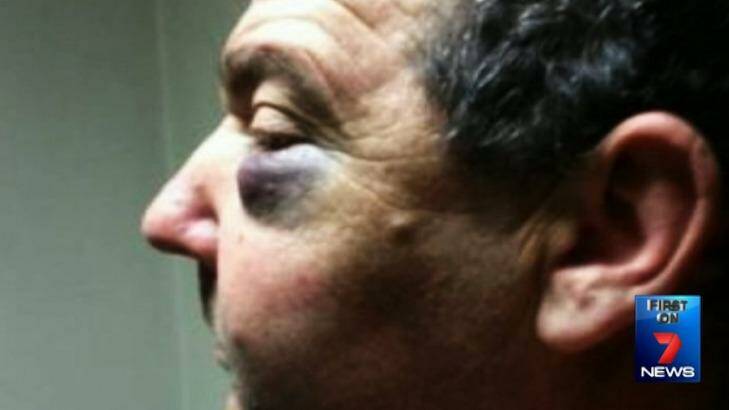 Karl Nissen was left with fractures in his face after he was attacked by David Mulligan on an Alexandria street. Photo: Channel Seven