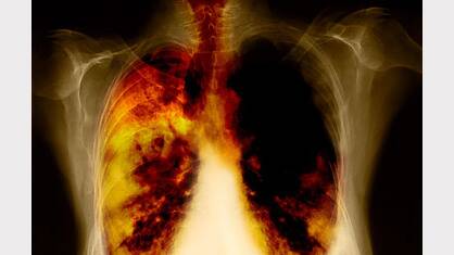 November is Lung Cancer Awareness Month. 