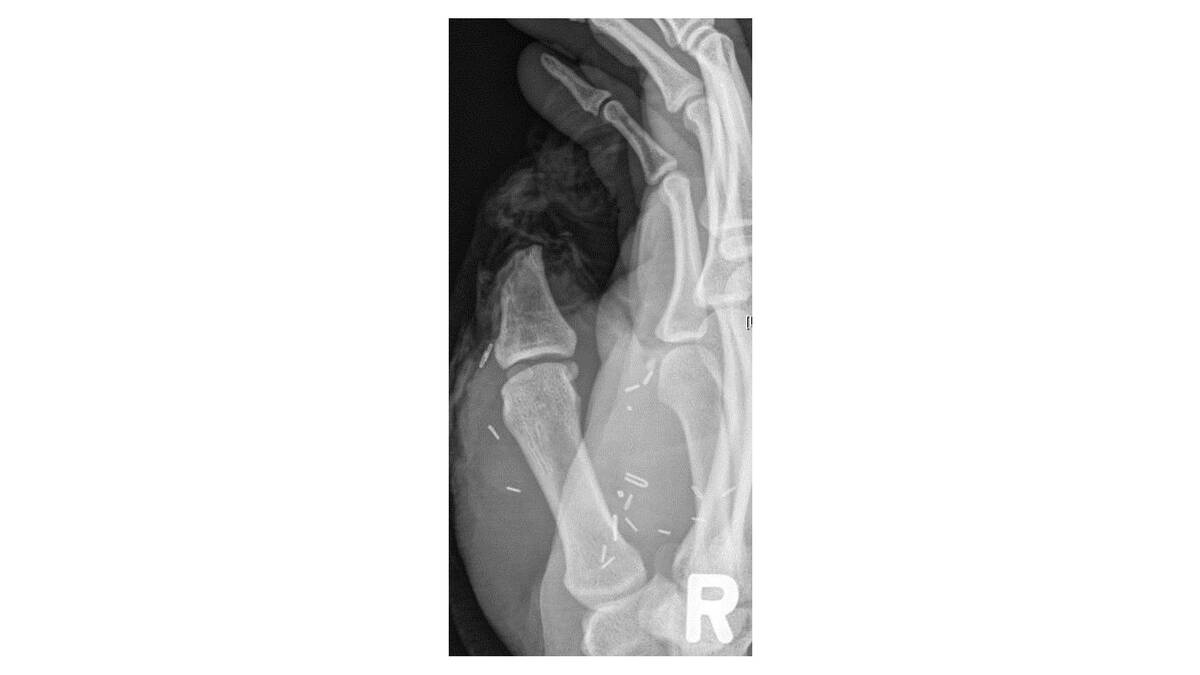 An x-ray of Zac Mitchell's hand following the accident. Photo: SOUTH EASTERN SYDNEY LOCAL HEALTH DISTRICT