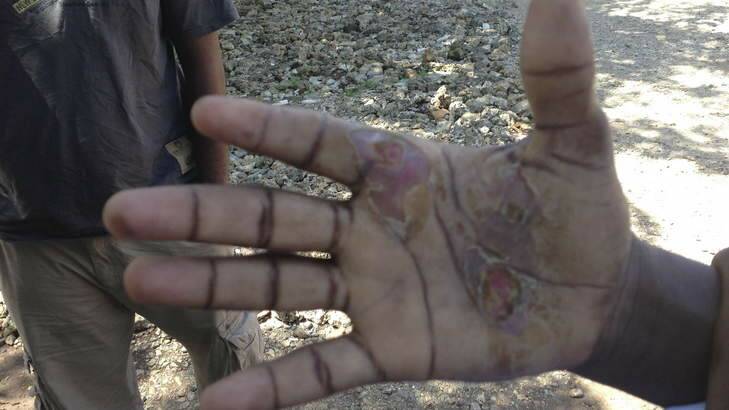 The hand of an asylum seeker, whom the Australian Navy allegedly abused. Photo: Amilia Rosa