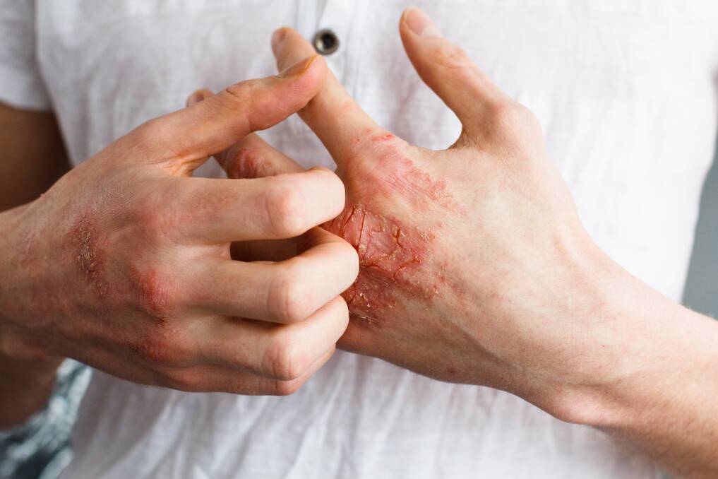 For many patients, eczema can be a roller coaster ride. Picture: Shutterstock.